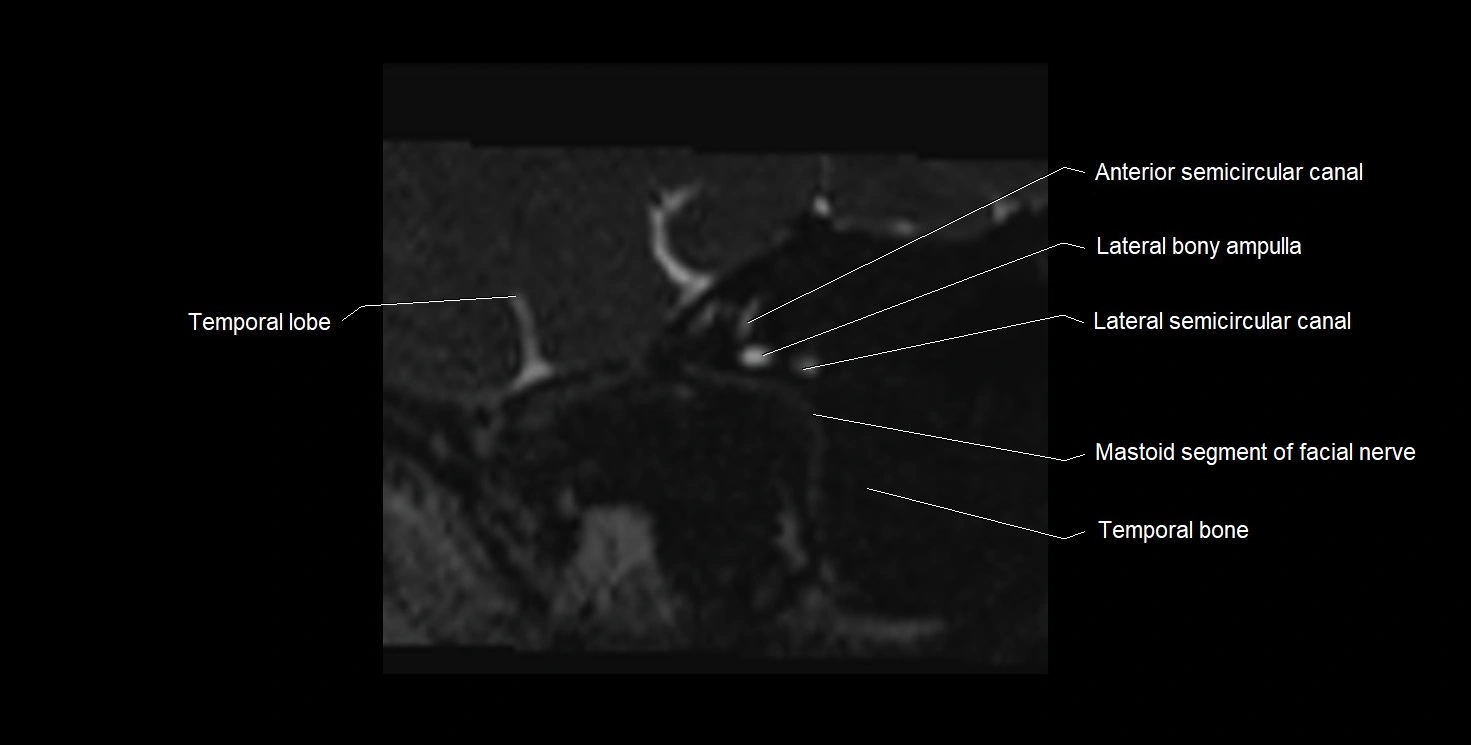 Internal auditory meatus (IAM) 3T sagittal cross sectional anatomy image 3.webp